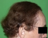 Hajátültetés után, FUT módszer